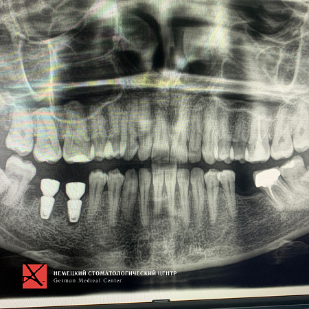 Удаление сломанного зуба и имплантация