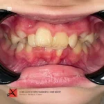 Фото работы Исправление прикуса у 9-летней пациентки 2 мини