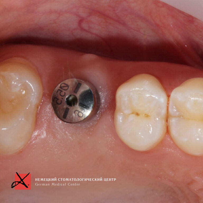 Фото работы Костная пластика с последующей имплантацией 3
