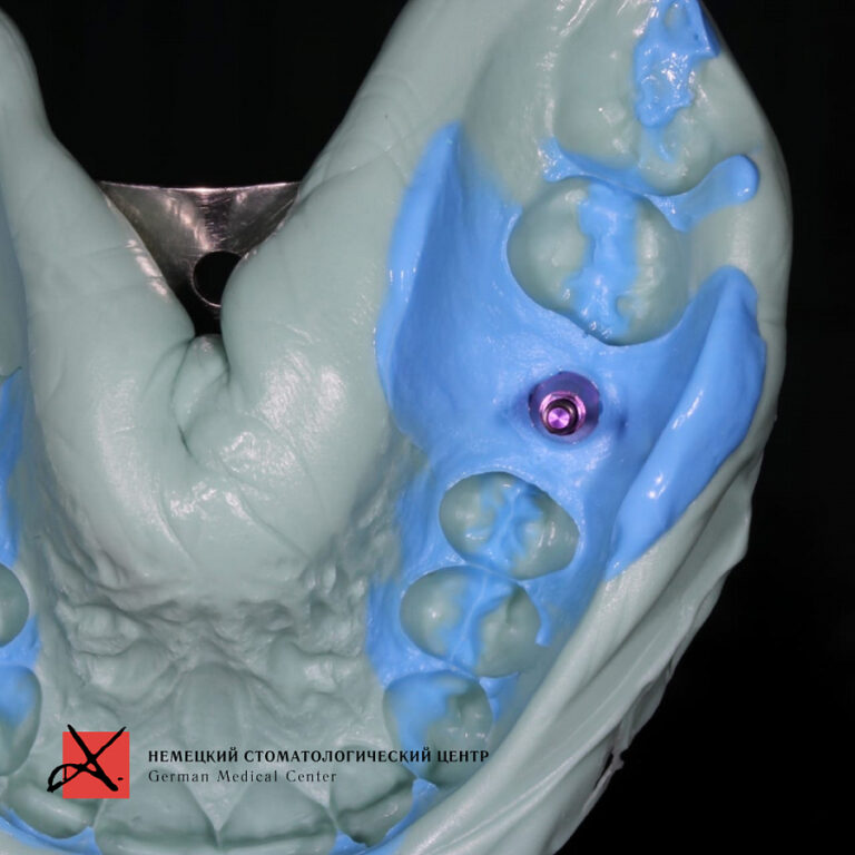 Фото работы Костная пластика с последующей имплантацией 1