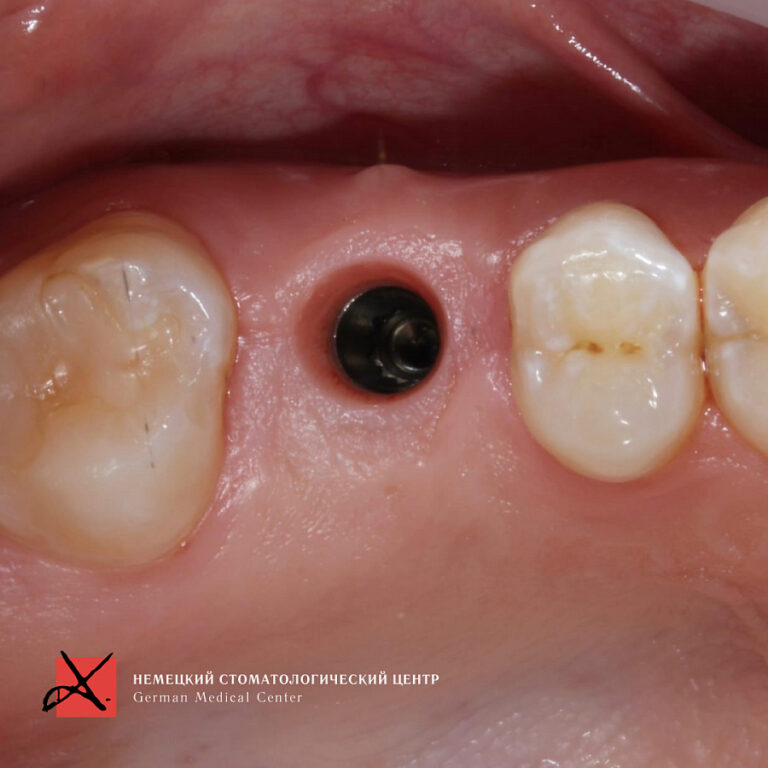 Фото работы Костная пластика с последующей имплантацией 6