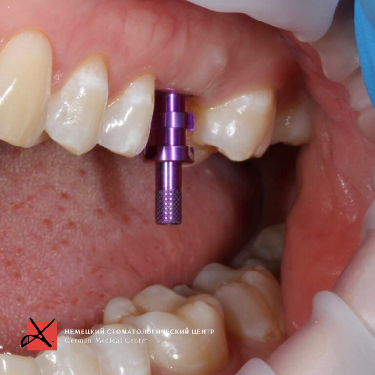 Фото работы Костная пластика с последующей имплантацией 7
