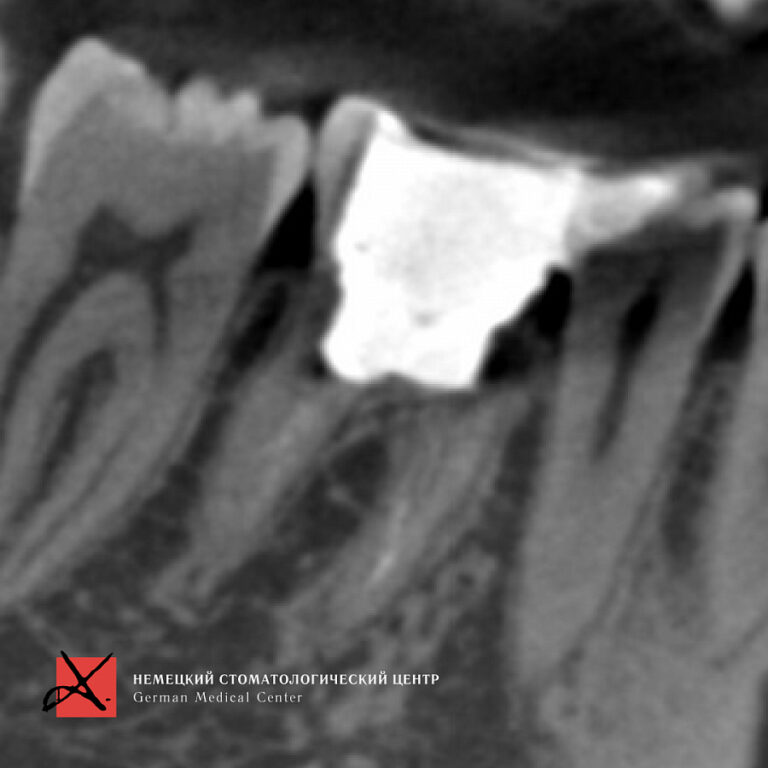 Фото работы Удаление зуба и одновременная имплантация 6